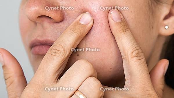 Close up of young woman pressing fingers to red irritated cheek skin, visible inflammation and sensitivity, skincare mock up concept for cosmetic product advertising and dermatology treatment themes [IBR125405003]