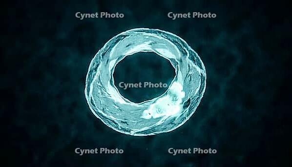 Abstract glowing teal cyan cross-sectional ring visualization representing cardiac MRI T2 tissue mapping, localized bright zone, dark background, clinical macro photography, AI generated [IBR125421257]