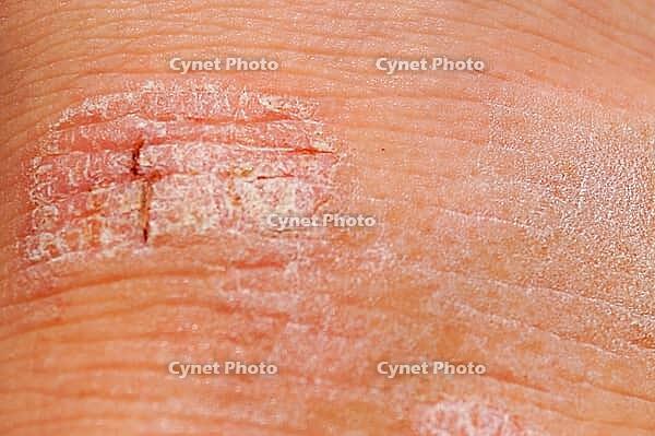 Psoriasis dry red and white irritant on skin close-up. Medical use image [IBR125462062]